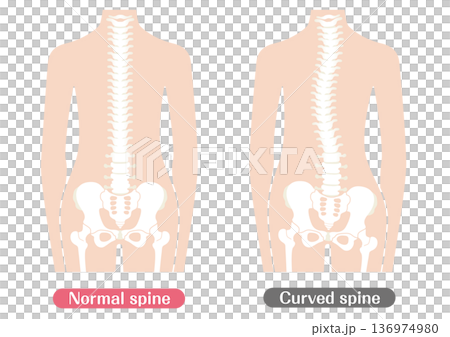 Comparison illustration of normal and abnormal spine | Color 136974980