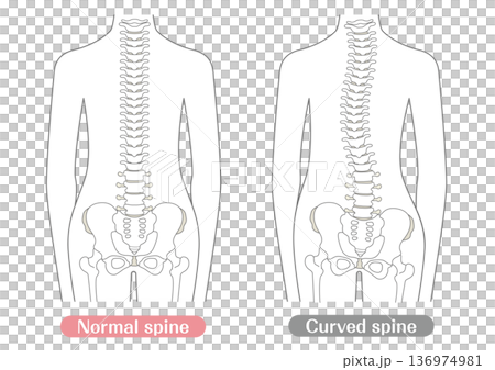 Comparison illustration of normal and abnormal spine | Line Comparison illustration of normal and abnormal spine | Line 136974981