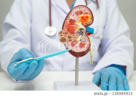 Chronic kidney disease, doctor with model for treatment urinary system, urology, Estimated glomerular filtration rate eGFR. Chronic kidney disease, doctor with model for treatment urinary system, urology, Estimated glomerular filtration rate eGFR. 136984913