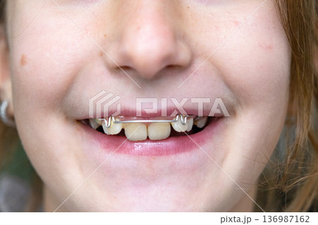 Close-up on girl's teeth, orthodontic plate visible, device for tooth alignment and bite improvement. 136987162