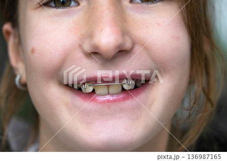Portrait, open smile with healthy teeth, before/after orthodontic correction plate, emotional comfort for child. Portrait, open smile with healthy teeth, before/after orthodontic correction plate, emotional comfort for child. 136987165