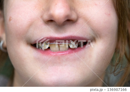 Smile with visible gaps in mixed dentition, ready for orthodontic correction and expansion plate fitting. Smile with visible gaps in mixed dentition, ready for orthodontic correction and expansion plate fitting. 136987166