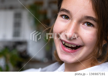 Happy child smiles after wearing removable dental plate, orthodontic appliance for pediatric care. Happy child smiles after wearing removable dental plate, orthodontic appliance for pediatric care. 136987191