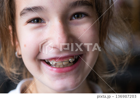 Girl laughs after plate treatment, positive emotions and healthy teeth after pediatric orthodontics. Girl laughs after plate treatment, positive emotions and healthy teeth after pediatric orthodontics. 136987203