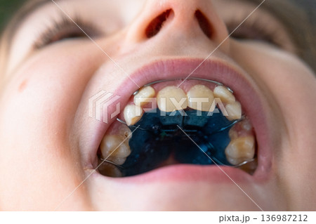Extreme close-up: upper jaw with blue orthodontic expander, pediatric palate correction device visible. Extreme close-up: upper jaw with blue orthodontic expander, pediatric palate correction device visible. 136987212