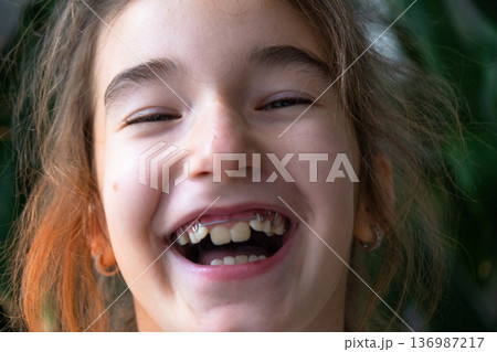 Child laughing after using removable orthodontic device, healthy teeth and positive experience at pediatric dentist. Child laughing after using removable orthodontic device, healthy teeth and positive experience at pediatric dentist. 136987217