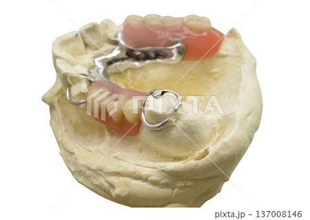 Partial removable denture on dental cast for prosthetic restoration Partial removable denture on dental cast for prosthetic restoration 137008146