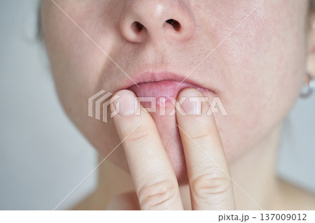 Caucasian female adult with cold sore on lip touching mouth close-up 137009012