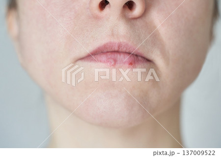 Close-up of adult caucasian females chapped lips highlighting skin texture and imperfections Close-up of adult caucasian females chapped lips highlighting skin texture and imperfections 137009522