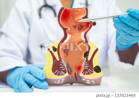 Asian doctor with rectum and hemorrhoid human anatomy model at hospital, inflamed vascular structure. Asian doctor with rectum and hemorrhoid human anatomy model at hospital, inflamed vascular structure. 137023460