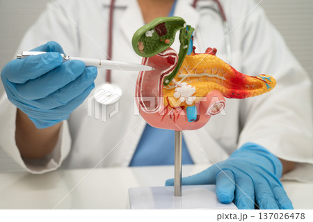 Pancreatitis, pancreatic cancer, Asian doctor with pancreas, gallbladder and bile duct human anatomy model at hospital. 137026478