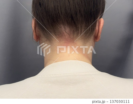 atopic dermatitis in an adult young girl has red scaly spots on the back of the neck close-up 137030111