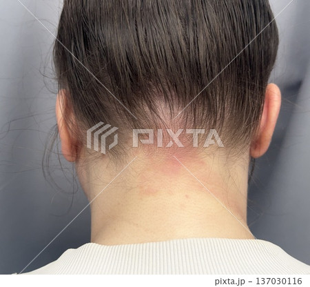 atopic dermatitis in an adult young girl has red scaly spots on the back of the neck close-up atopic dermatitis in an adult young girl has red scaly spots on the back of the neck close-up 137030116