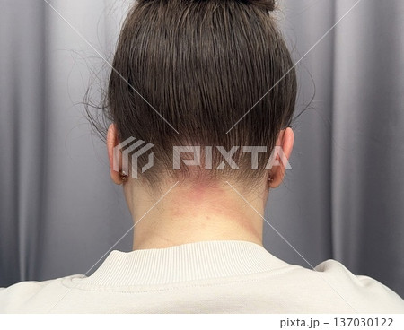 atopic dermatitis in an adult young girl has red scaly spots on the back of the neck close-up atopic dermatitis in an adult young girl has red scaly spots on the back of the neck close-up 137030122