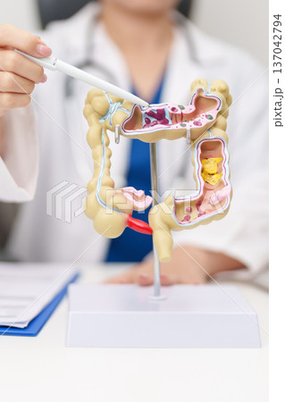 Doctor with human Colon anatomy model. Colonic disease, Large Intestine, Colorectal cancer, Ulcerative colitis, Diverticulitis, Irritable bowel syndrome, Digestive system and Healthcare concept Doctor with human Colon anatomy model. Colonic disease, Large Intestine, Colorectal cancer, Ulcerative colitis, Diverticulitis, Irritable bowel syndrome, Digestive system and Healthcare concept 137042794
