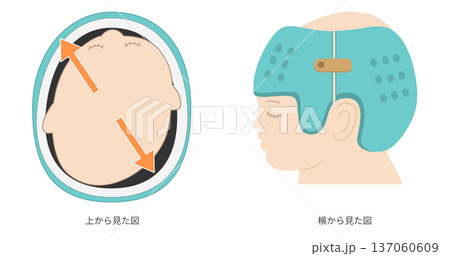 斜頭症に対するヘルメット治療の仕組みを示した図解（成長誘導による頭蓋矯正） 137060609