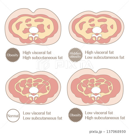 肥満タイプと脂肪分布の分類イラスト（標準・肥満・隠れ肥満） 137068930