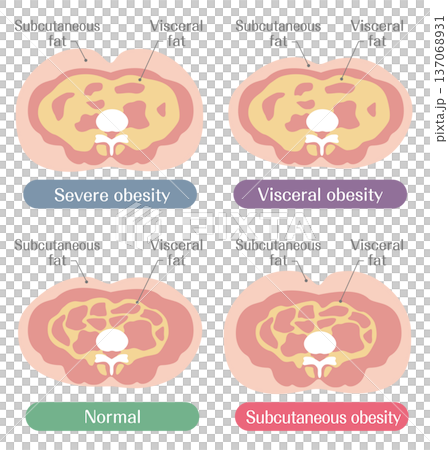 Illustration comparing obesity levels and fat types (severe obesity, visceral fat, subcutaneous fat, normal) 137068931