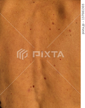 Close-up of human skin with multiple moles and pigmented nevi on the back. Close-up of human skin with multiple moles and pigmented nevi on the back. 137081303