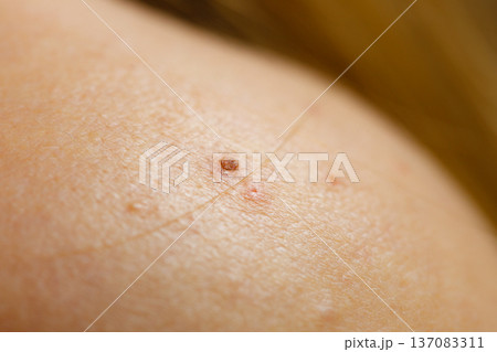 Closeup skin with acne moles and red spots. 137083311