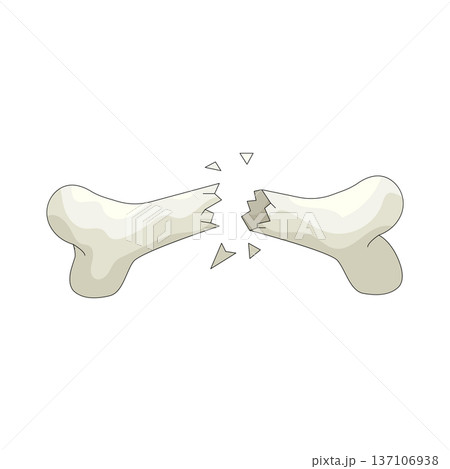 Illustration of Broken bone Illustration of Broken bone 137106938