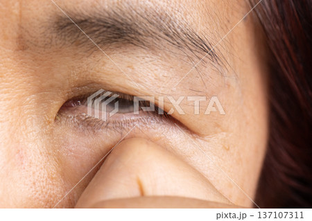 Senior woman has cataract. Generally, cataracts are common in older people. 137107311