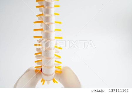 Spinal nerve and bone, Lumbar spine displaced herniated disc fragment, Model for treatment medical in the orthopedic department. Spinal nerve and bone, Lumbar spine displaced herniated disc fragment, Model for treatment medical in the orthopedic department. 137111162