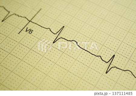Electrocardiogram (ECG), heart wave, heart attack, cardiogram report. Electrocardiogram (ECG), heart wave, heart attack, cardiogram report. 137111485