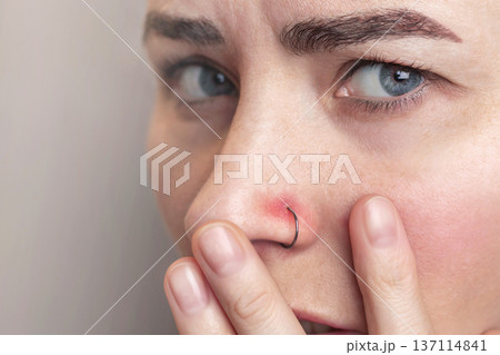 Close up photo of woman suffers and experiences pain from a nose piercing. Inflamed piercing, nose after piercing. Red nose piercing site. 137114841