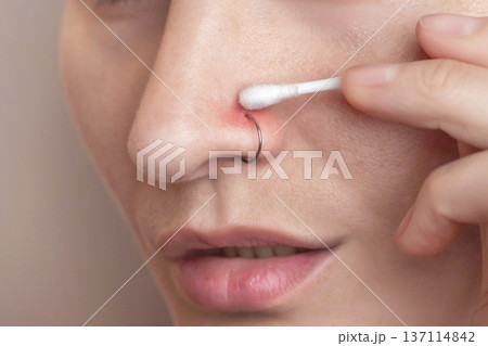 An inflamed nose piercing. A woman swabbing the piercing site with chlorhexidine on a cotton swab. Post-piercing care. Close up photo 137114842