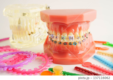 Orthodontic ligatures rings and ties, elastic rubber bands on orthodontic braces, model for dentist studying about dentistry. 137116062