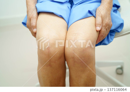 Asian elderly woman patient with scar knee replacement surgery in hospital. 137116064