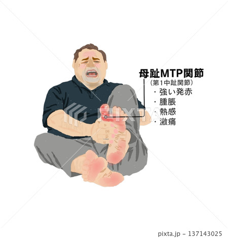 痛風発作で母趾MTP関節に強い発赤・腫脹・熱感・激痛が出現した中高年男性のイラスト 137143025