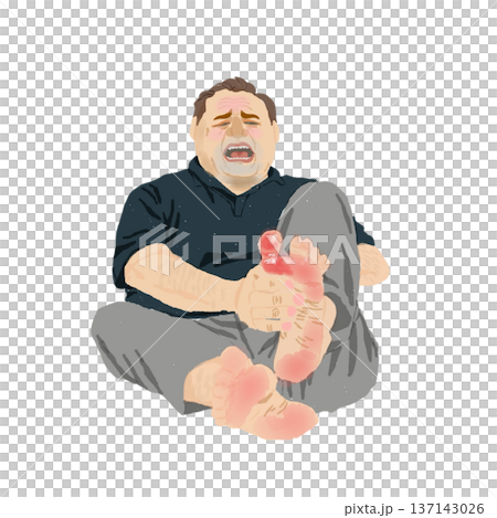Illustration of a middle-aged man experiencing severe redness, swelling, heat, and pain in the MTP joint of the big toe due to a gout attack 137143026