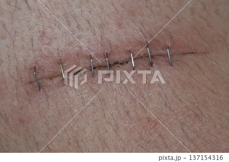 deep cut with several staples to facilitate healing deep cut with several staples to facilitate healing 137154316