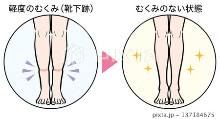 軽度のむくみ（靴下跡）からむくみのない状態への変化 137184675