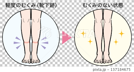 軽度のむくみ（靴下跡）からむくみのない状態への変化 137184675