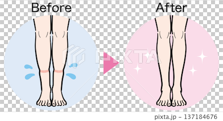 腿部輕微腫脹（襪印）前後對比 137184676