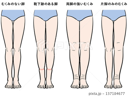 脚のむくみの症状比較(靴下跡・両脚むくみ・片脚のみ) 脚のむくみの症状比較(靴下跡・両脚むくみ・片脚のみ) 137184677