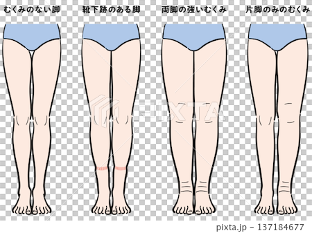 腿部腫脹症狀對比（襪印、雙腿腫脹、單腳腫脹） 137184677