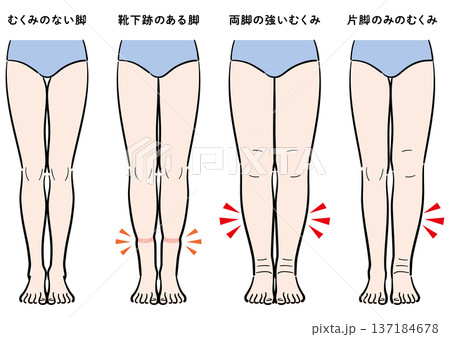 脚のむくみの症状比較(靴下跡・両脚むくみ・片脚のみ) 脚のむくみの症状比較(靴下跡・両脚むくみ・片脚のみ) 137184678