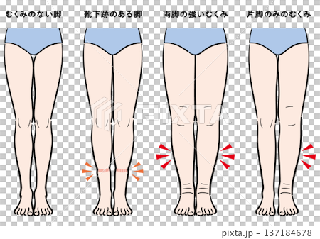 腿部腫脹症狀對比（襪印、雙腿腫脹、單腳腫脹） 137184678
