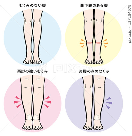 脚のむくみの症状比較(靴下跡・両脚むくみ・片脚のみ)背景色ありタイプ 脚のむくみの症状比較(靴下跡・両脚むくみ・片脚のみ)背景色ありタイプ 137184679