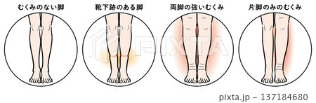 脚のむくみの症状比較（靴下跡・両脚むくみ・片脚のみ） 137184680