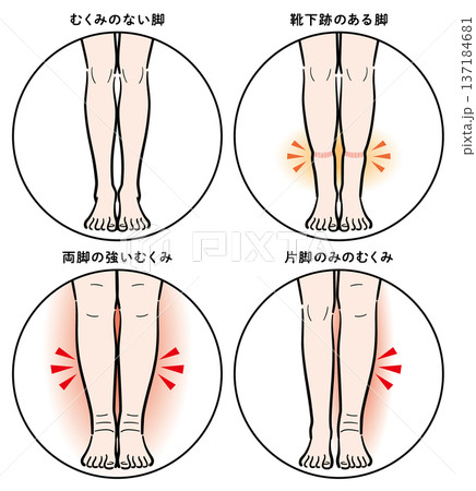 脚のむくみの症状比較(靴下跡・両脚むくみ・片脚のみ) 脚のむくみの症状比較(靴下跡・両脚むくみ・片脚のみ) 137184681