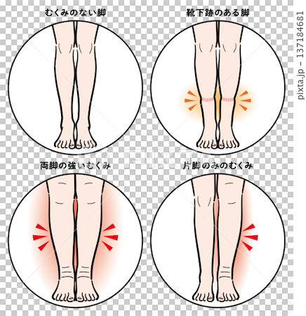 脚のむくみの症状比較(靴下跡・両脚むくみ・片脚のみ) 脚のむくみの症状比較(靴下跡・両脚むくみ・片脚のみ) 137184681