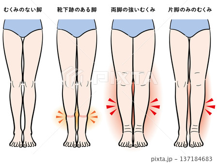 脚のむくみの症状比較(靴下跡・両脚むくみ・片脚のみ) 脚のむくみの症状比較(靴下跡・両脚むくみ・片脚のみ) 137184683