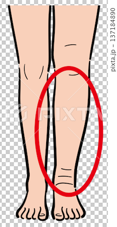 只有一條腿腫脹 137184890