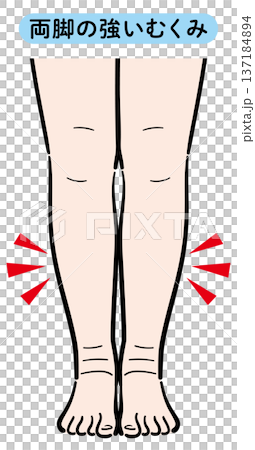 Severe swelling in both legs 137184894