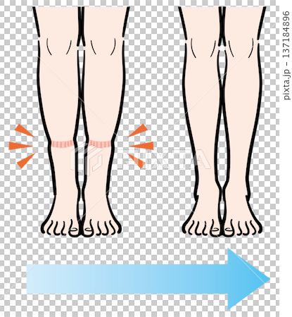 腿部輕微腫脹（襪子印記）變成腿部腫脹消失 137184896